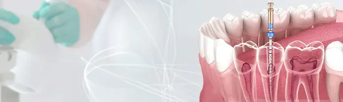 Root Canal Treatment for an Infected Tooth: Is It Possible?
