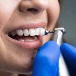 Scaling & Polishing