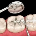 Root Canal & Fillings