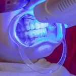 Scaling & Polishing