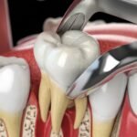 Tooth Extractions
