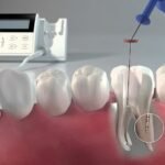 Root Canal & Fillings